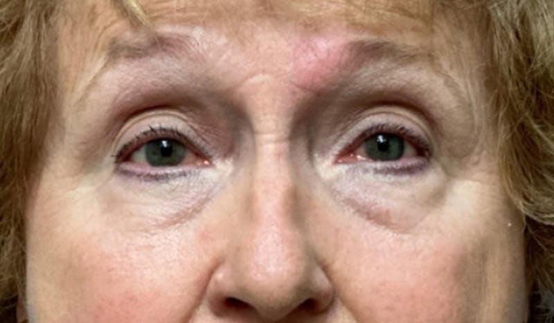 Eyelid Surgery Before & After Gallery - Patient 328698 - Image 1