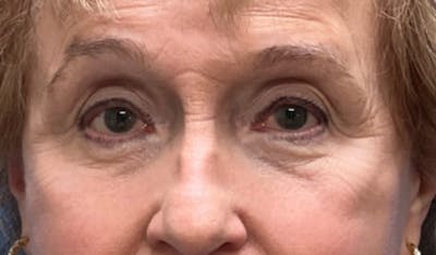 Eyelid Surgery Before & After Gallery - Patient 328698 - Image 2