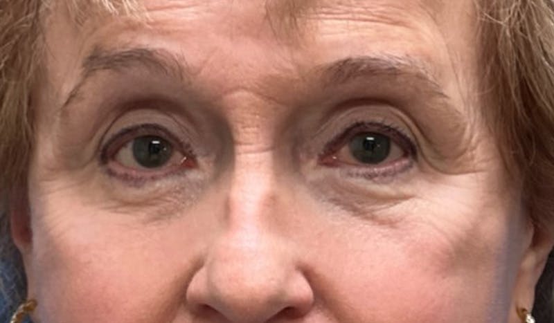 Eyelid Surgery Before & After Gallery - Patient 328698 - Image 2