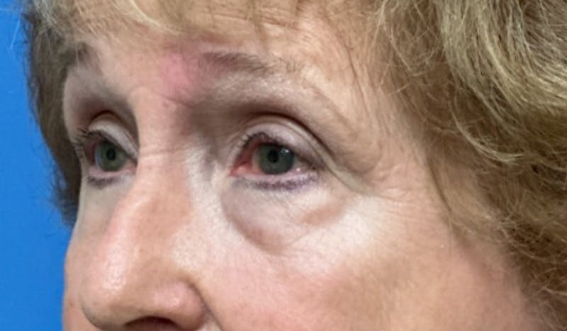 Eyelid Surgery Before & After Gallery - Patient 328698 - Image 3