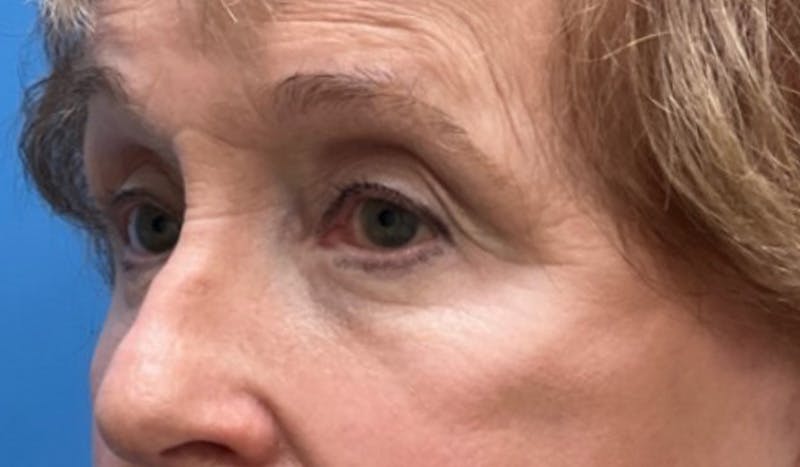 Eyelid Surgery Before & After Gallery - Patient 328698 - Image 4