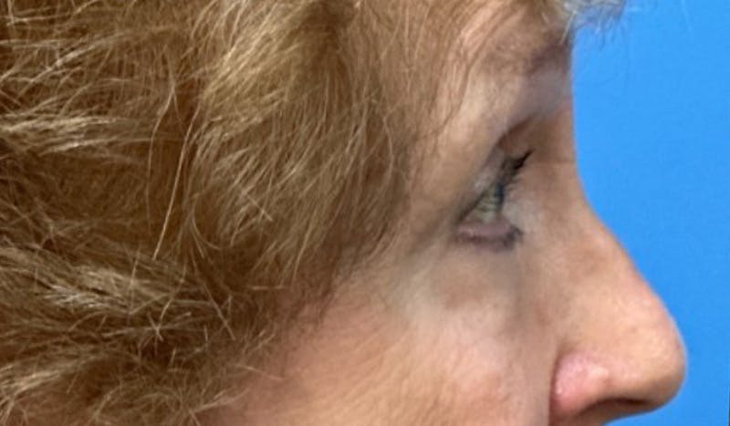 Eyelid Surgery Before & After Gallery - Patient 328698 - Image 5