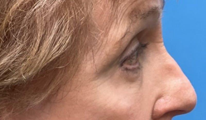 Eyelid Surgery Before & After Gallery - Patient 328698 - Image 6