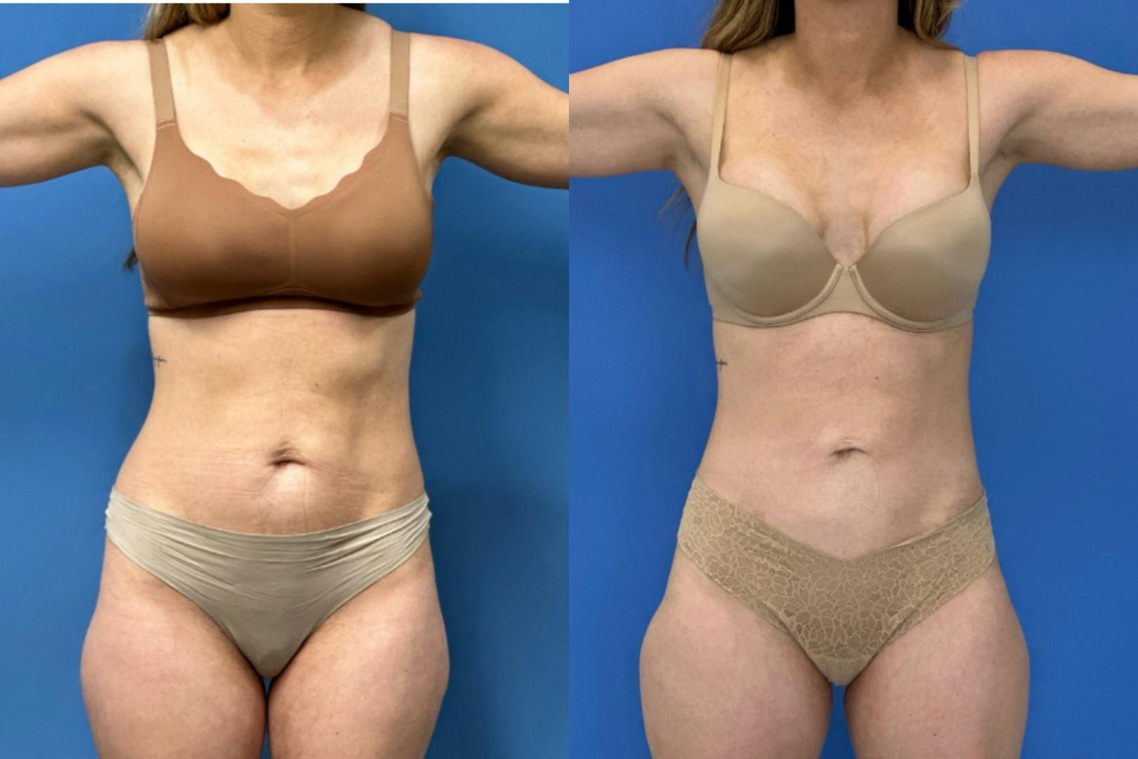 Liposuction Before & After Gallery - Patient 865133 - Image 2