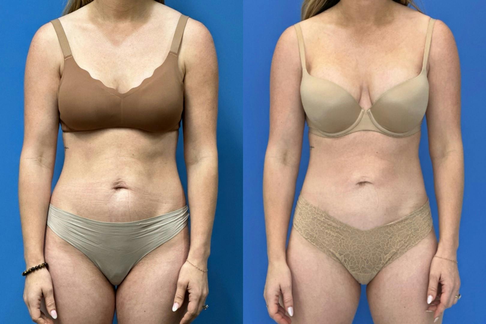 Liposuction Before & After Gallery - Patient 865133 - Image 1