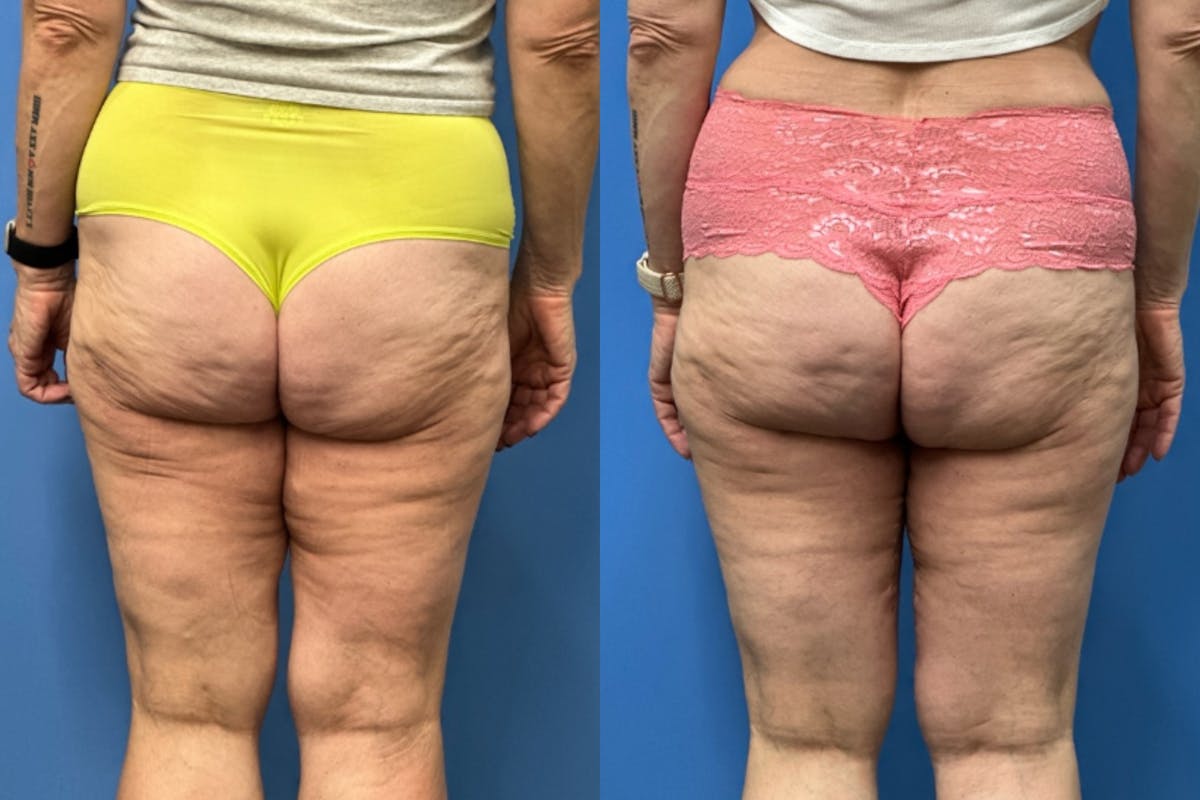 Thigh Lift Before & After Gallery - Patient 281283 - Image 2