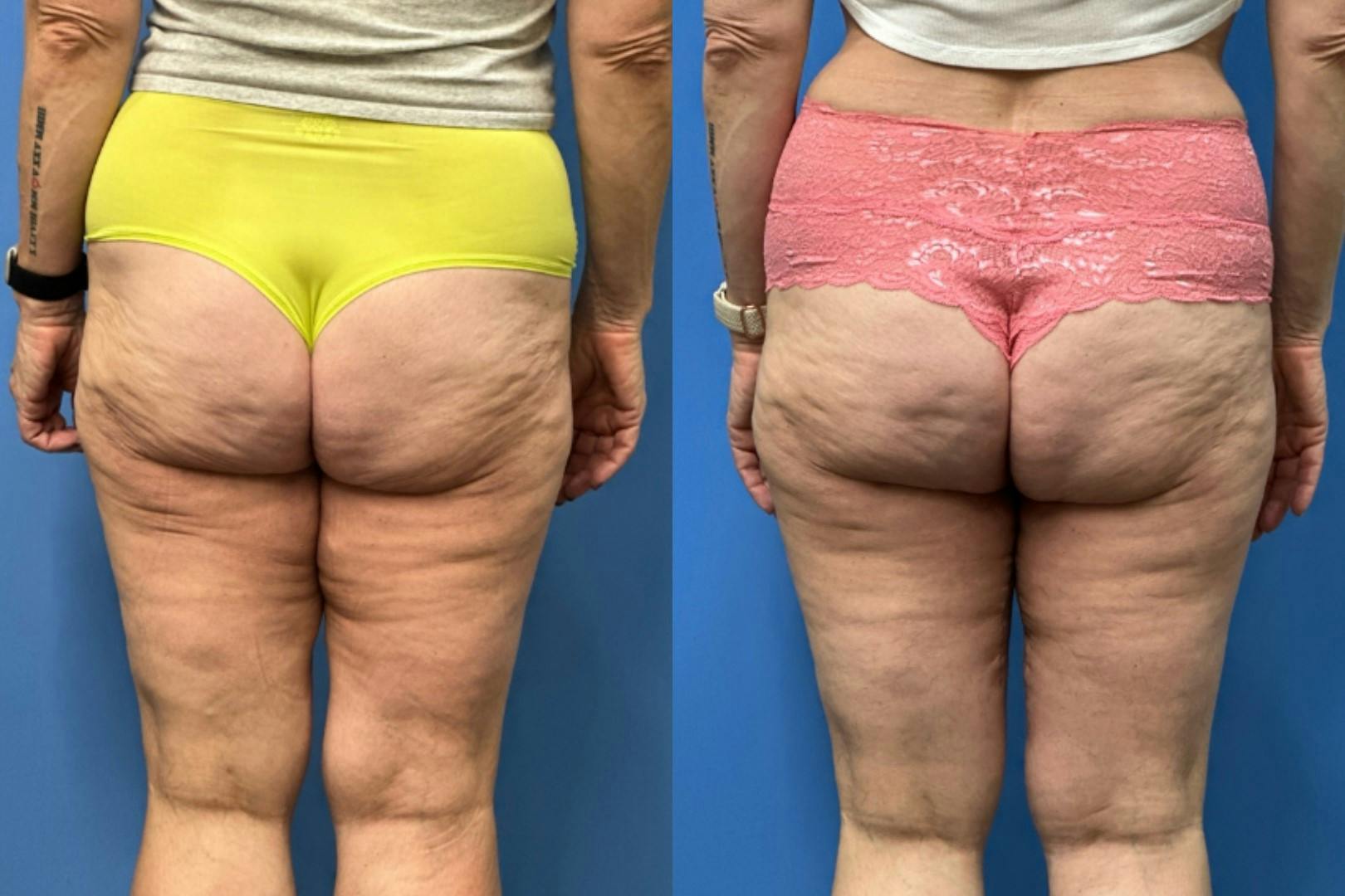 Thigh Lift Before & After Gallery - Patient 281283 - Image 2