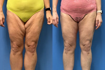 Thigh Lift Before & After Gallery - Patient 281283 - Image 1