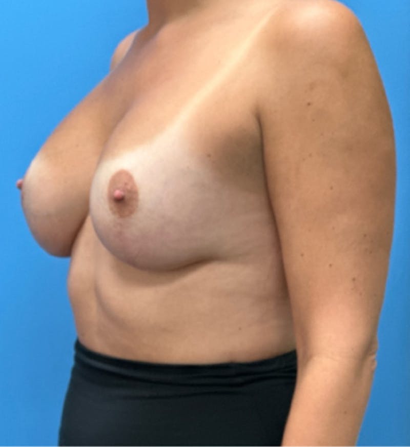 Breast Lift Before & After Gallery - Patient 270062 - Image 6