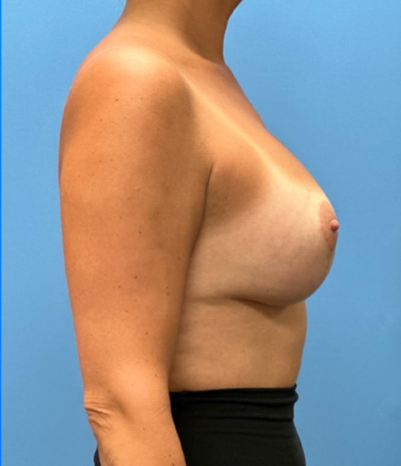 Breast Lift Before & After Gallery - Patient 270062 - Image 8