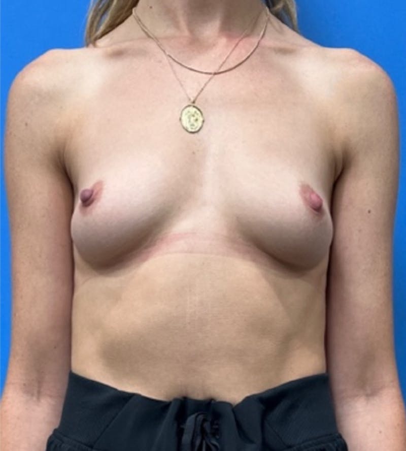 Breast Augmentation Before & After Gallery - Patient 129452 - Image 1
