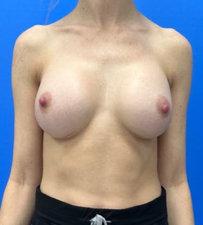 Breast Augmentation Before & After Gallery - Patient 129452 - Image 2
