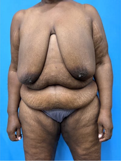 Brachioplasty Before & After Gallery - Patient 395926 - Image 1