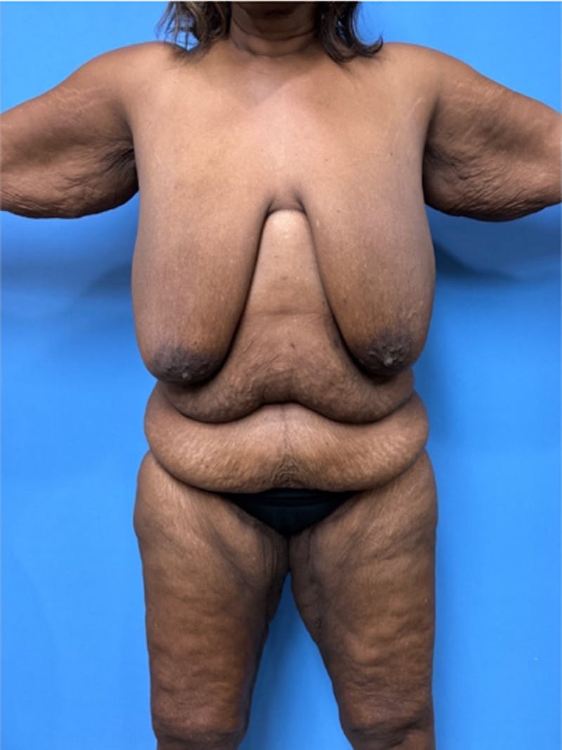 Brachioplasty Before & After Gallery - Patient 395926 - Image 3