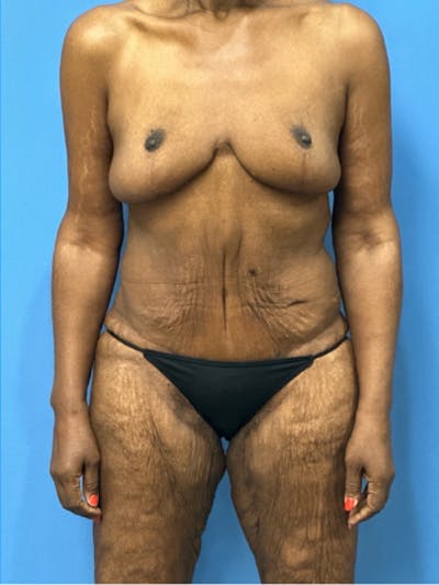 Brachioplasty Before & After Gallery - Patient 395926 - Image 2