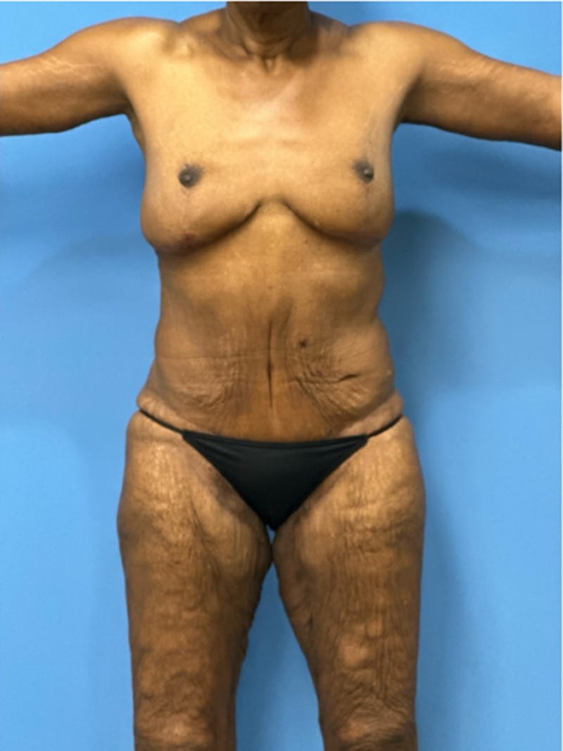 Brachioplasty Before & After Gallery - Patient 395926 - Image 4