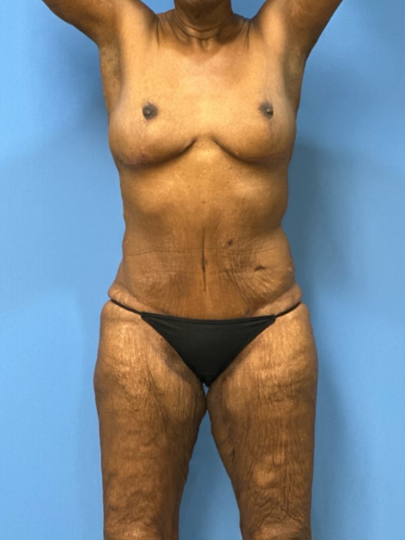 Brachioplasty Before & After Gallery - Patient 395926 - Image 6