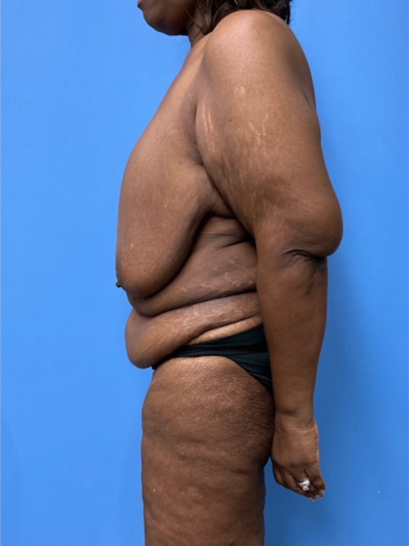 Brachioplasty Before & After Gallery - Patient 395926 - Image 7
