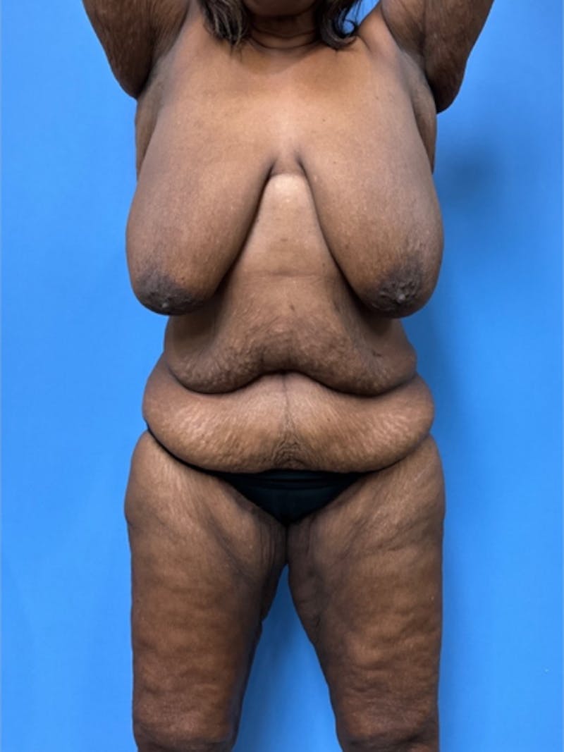 Brachioplasty Before & After Gallery - Patient 395926 - Image 5