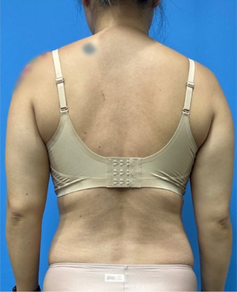 Liposuction Before & After Gallery - Patient 352686 - Image 3