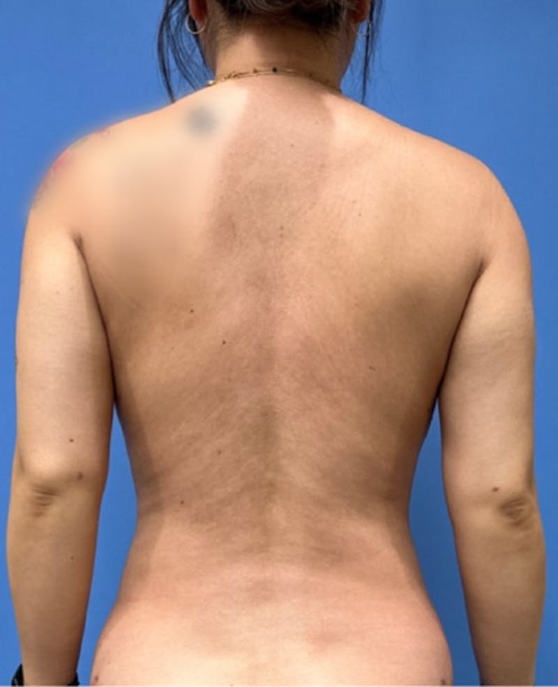 Liposuction Before & After Gallery - Patient 352686 - Image 4