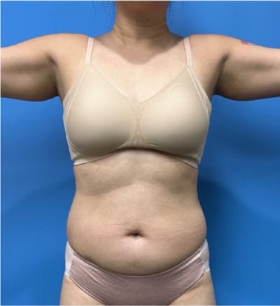 Liposuction Before & After Gallery - Patient 352686 - Image 1