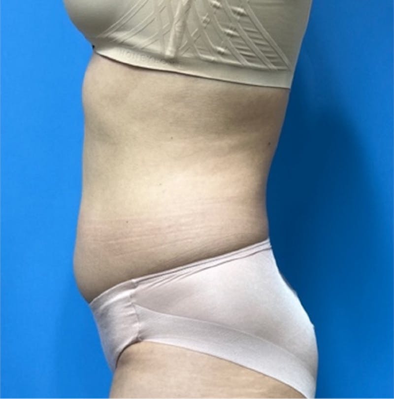 Liposuction Before & After Gallery - Patient 352686 - Image 5