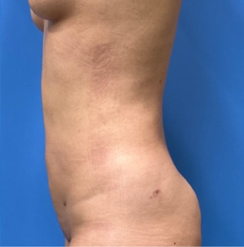 Liposuction Before & After Gallery - Patient 352686 - Image 6