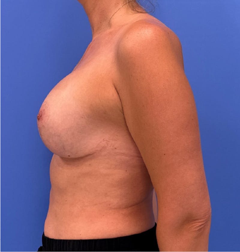 Breast Augmentation Before & After Gallery - Patient 134388 - Image 8