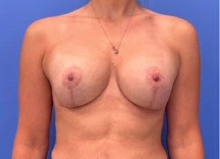 Breast Lift Before & After Gallery - Patient 312108 - Image 2