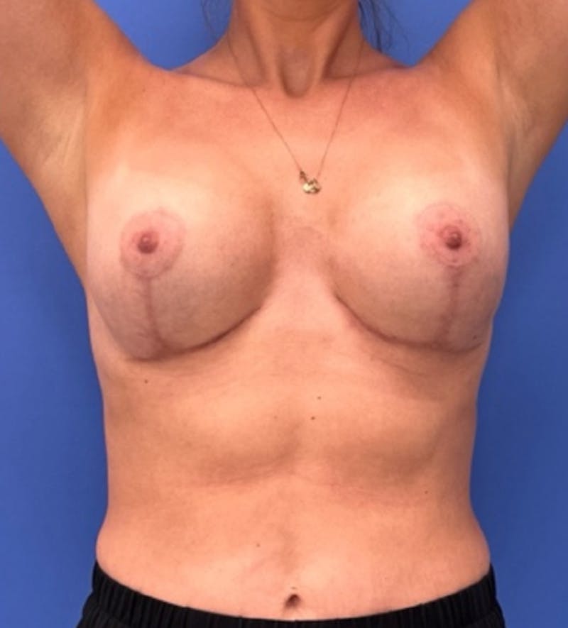 Breast Augmentation Before & After Gallery - Patient 134388 - Image 4