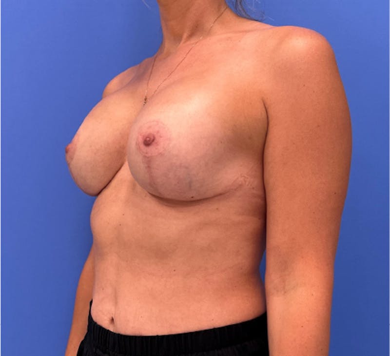 Breast Augmentation Before & After Gallery - Patient 134388 - Image 6