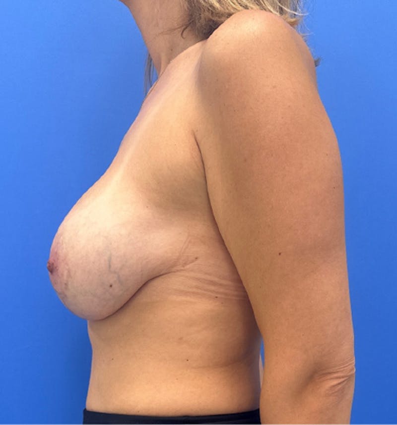 Breast Augmentation Before & After Gallery - Patient 134388 - Image 7