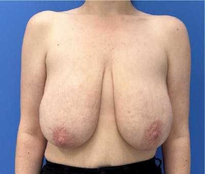 Breast Lift Before & After Gallery - Patient 368792 - Image 1