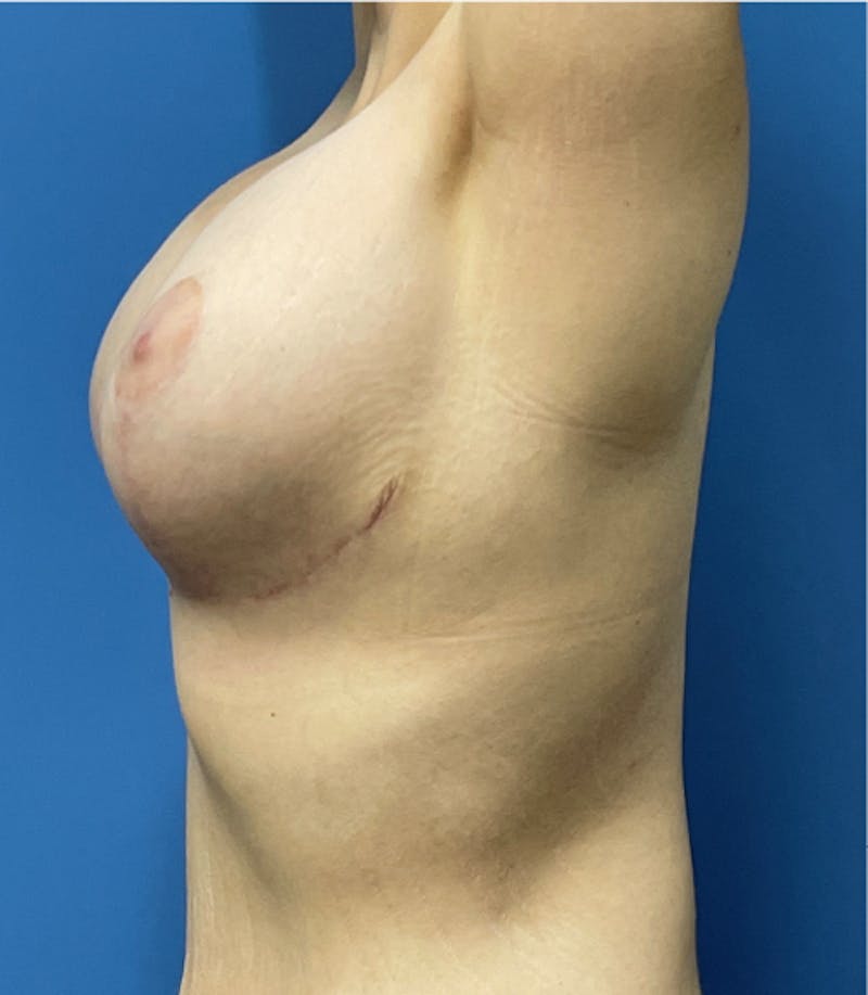 Breast Lift Before & After Gallery - Patient 368792 - Image 6