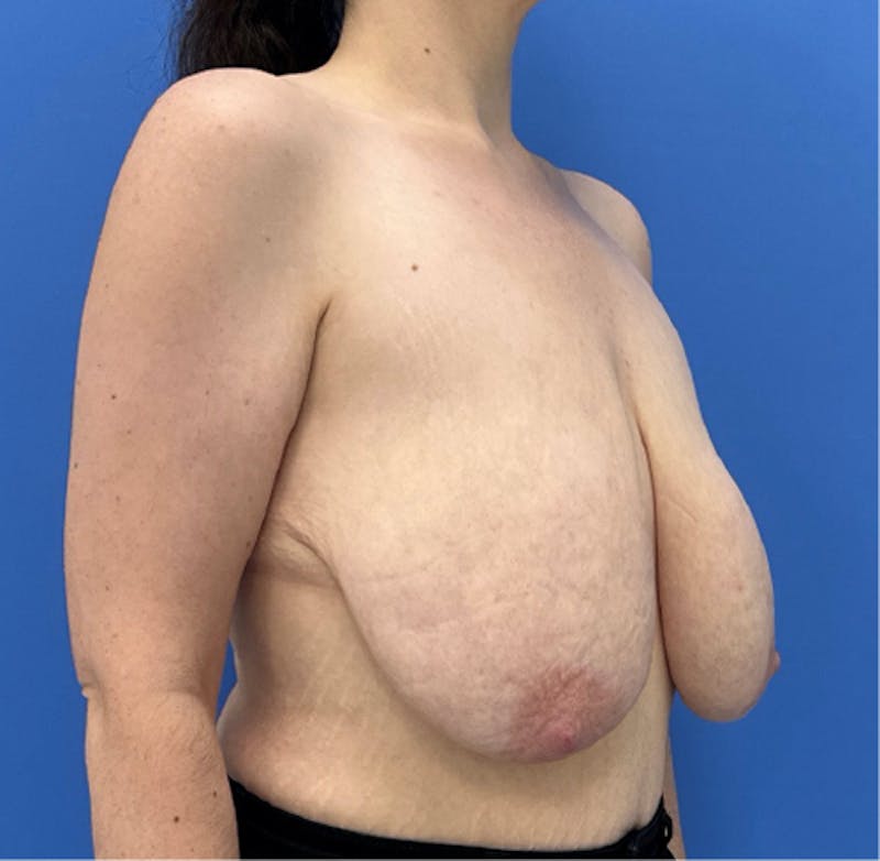 Breast Lift Before & After Gallery - Patient 368792 - Image 3
