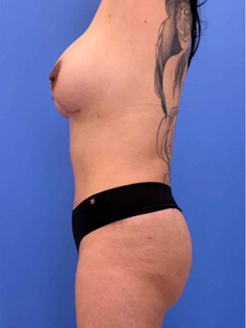Breast Augmentation Before & After Gallery - Patient 208022 - Image 6