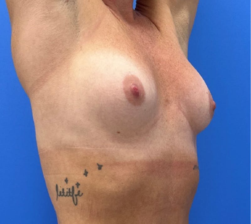 Breast Augmentation Before & After Gallery - Patient 378578 - Image 3