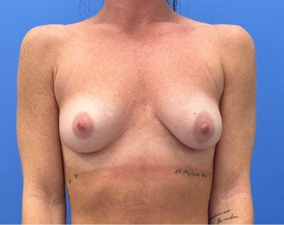 Breast Augmentation Before & After Gallery - Patient 378578 - Image 1
