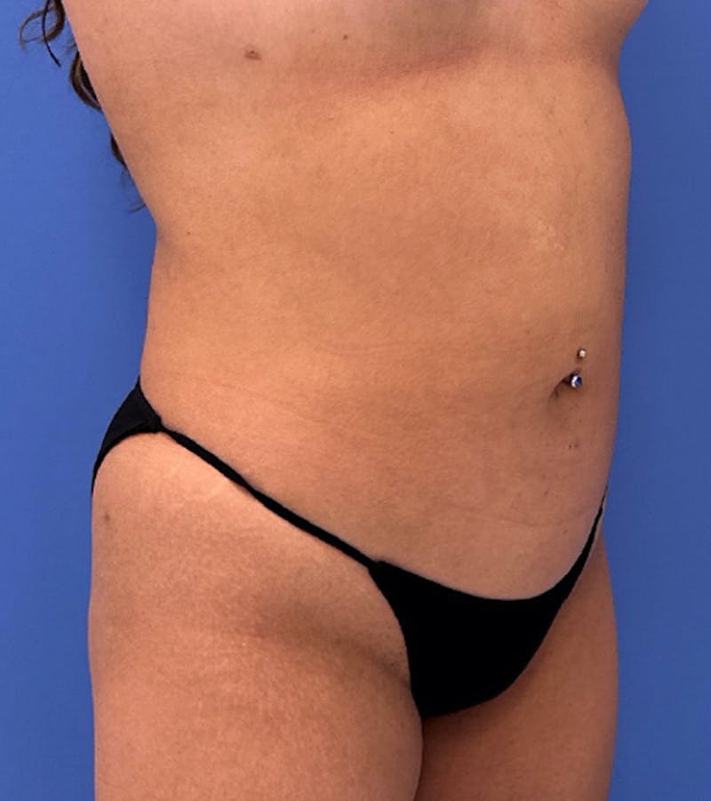 Liposuction Before & After Gallery - Patient 316645 - Image 4