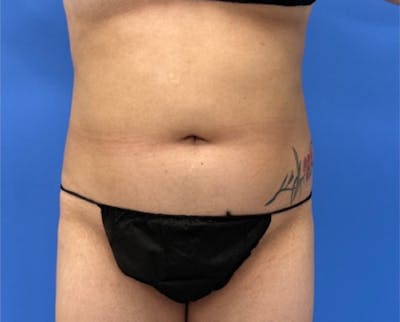 Liposuction Before & After Gallery - Patient 316645 - Image 1