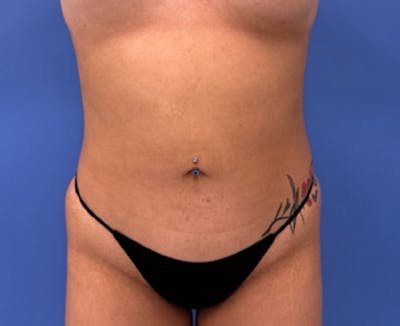 Liposuction Before & After Gallery - Patient 316645 - Image 2