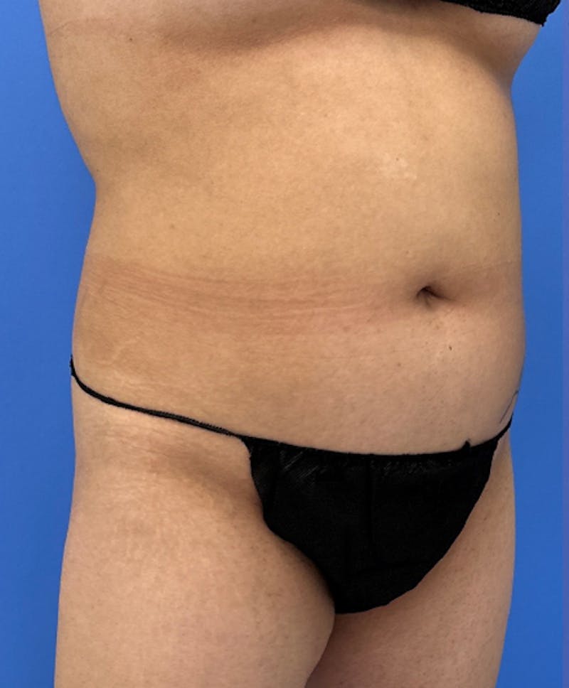 Liposuction Before & After Gallery - Patient 316645 - Image 3