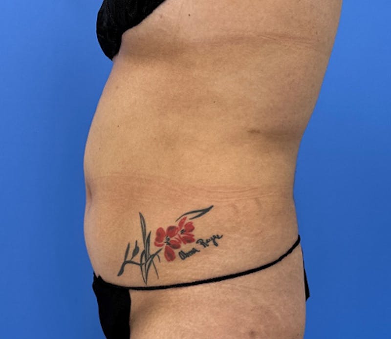 Liposuction Before & After Gallery - Patient 316645 - Image 5