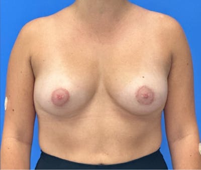 Breast Augmentation Before & After Gallery - Patient 351838 - Image 1