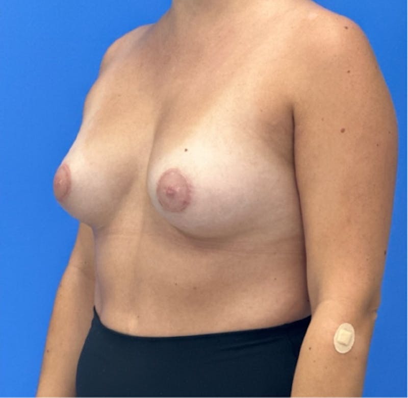 Breast Augmentation Before & After Gallery - Patient 351838 - Image 3