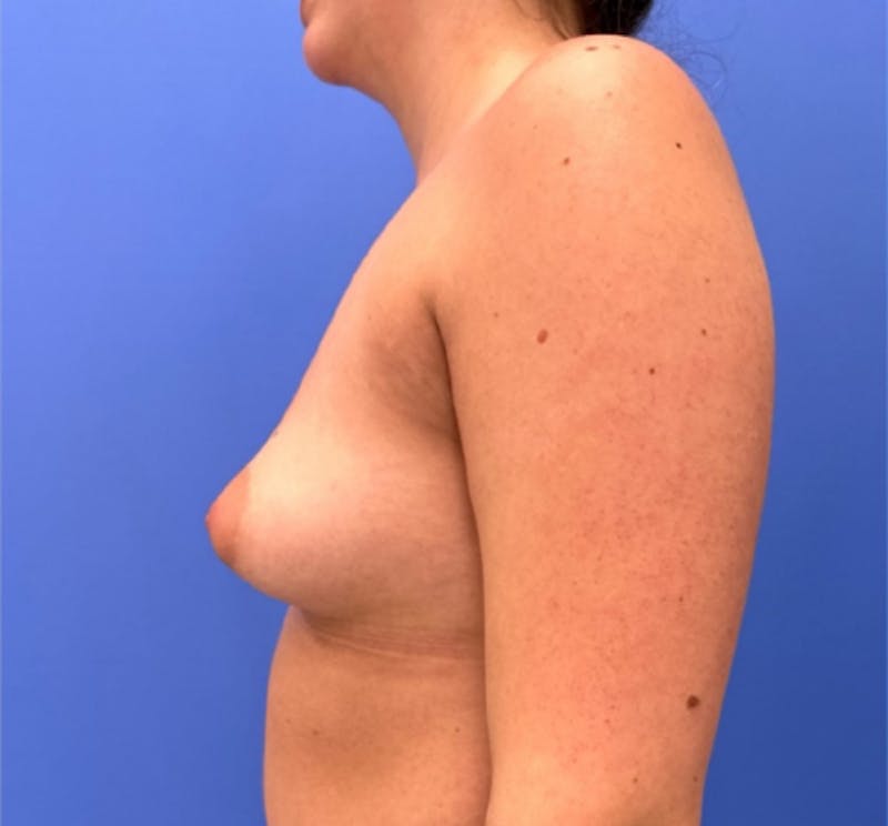 Breast Augmentation Before & After Gallery - Patient 351838 - Image 6
