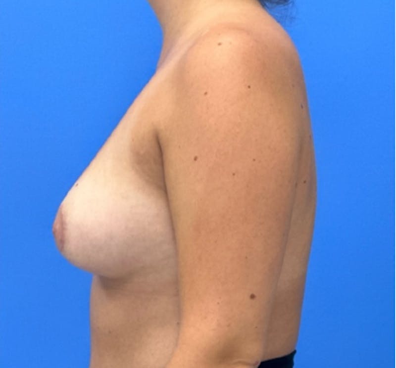 Breast Augmentation Before & After Gallery - Patient 351838 - Image 5