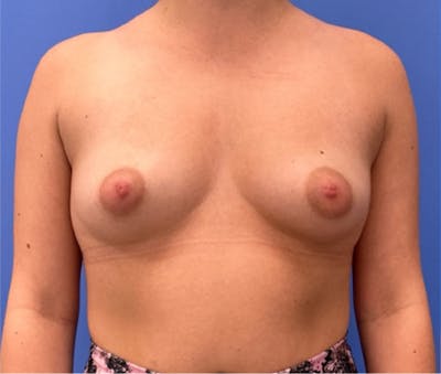 Breast Augmentation Before & After Gallery - Patient 351838 - Image 2