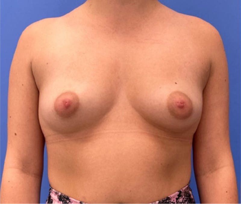 Breast Augmentation Before & After Gallery - Patient 351838 - Image 2
